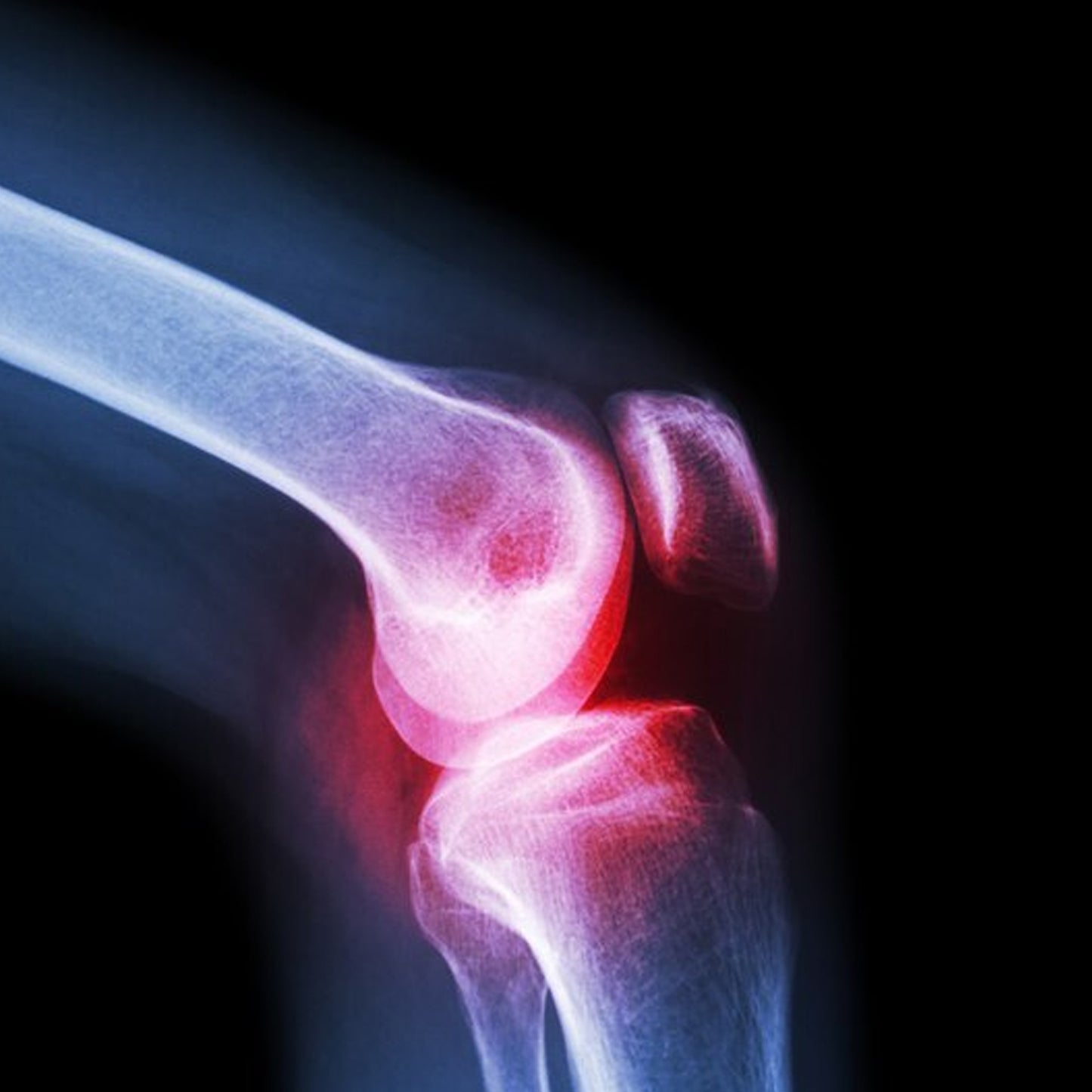 Knee Sleeve for Knee Support (Large) 1 pc